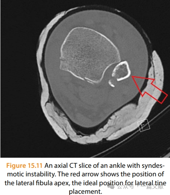 踝关节之下胫腓联合损伤，怎么看？怎么内固定？怎么避坑？