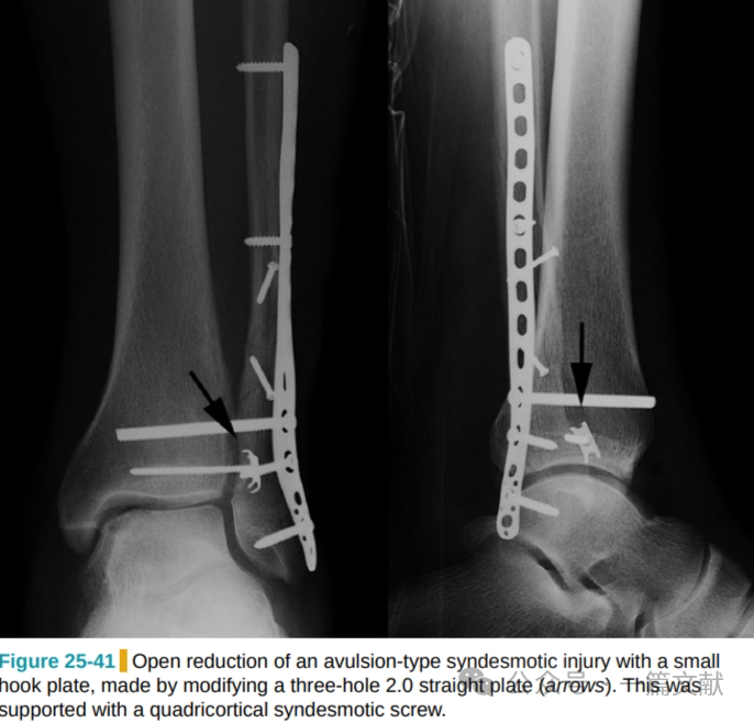 踝关节之下胫腓联合损伤，怎么看？怎么内固定？怎么避坑？