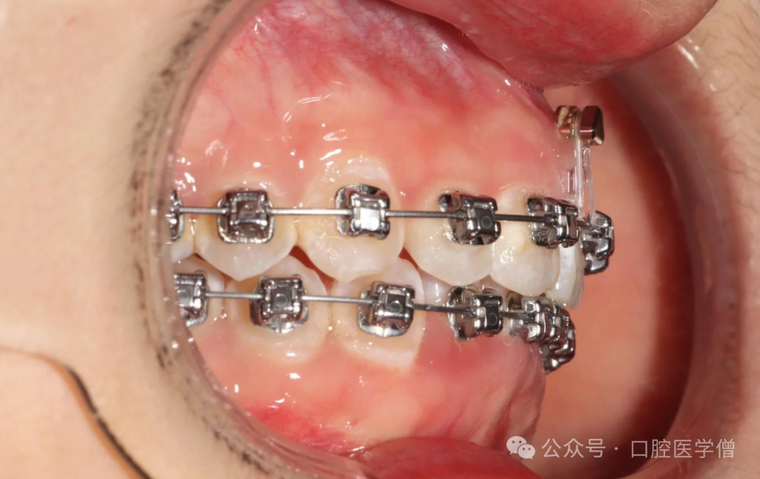 深覆颌矫正：何时压低前牙？何时升高后牙？