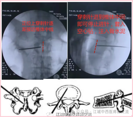 椎体成形术（PVP)：椎弓根安全入路与精准穿刺全攻略