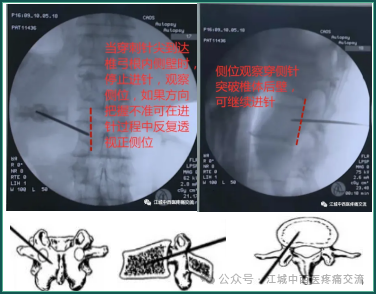 椎体成形术（PVP)：椎弓根安全入路与精准穿刺全攻略