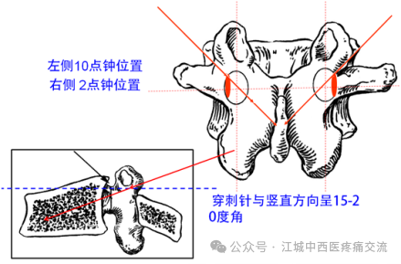 椎体成形术（PVP)：椎弓根安全入路与精准穿刺全攻略