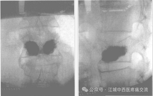 椎体成形术（PVP)：椎弓根安全入路与精准穿刺全攻略