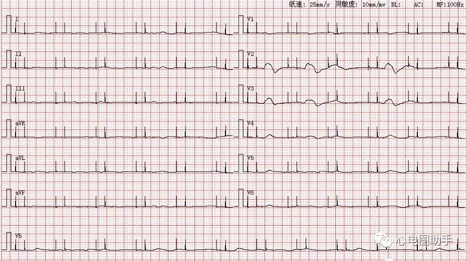 心电图如何报告死亡与濒死心电图​诊断