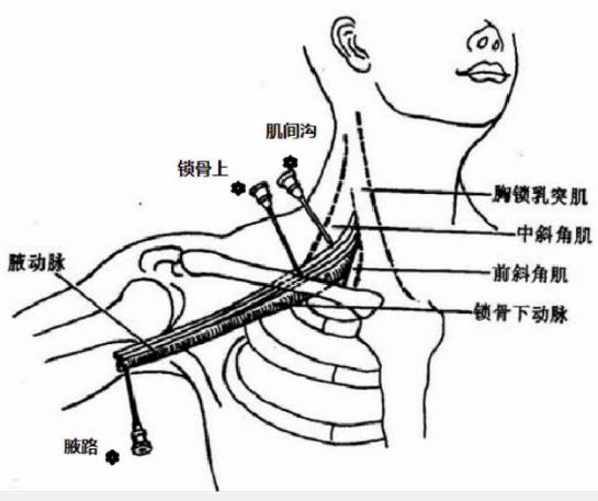 臂丛肌间沟最简单定位图片