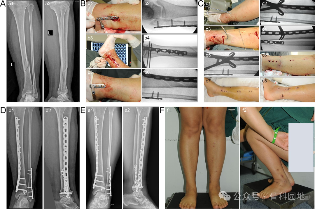 经皮钳形复位，微创钢板内固定治疗胫骨干骨折手术技术