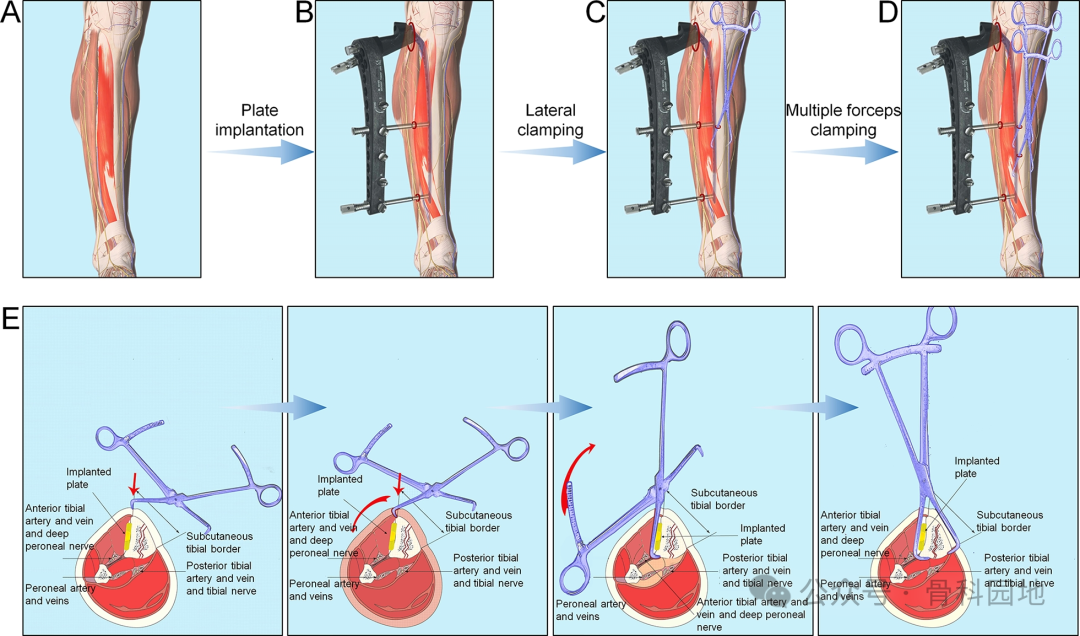 经皮钳形复位，微创钢板内固定治疗胫骨干骨折手术技术