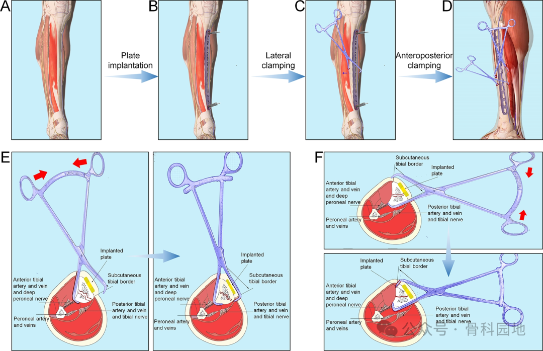 经皮钳形复位，微创钢板内固定治疗胫骨干骨折手术技术