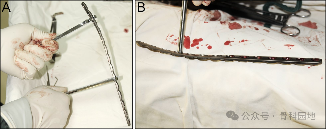 经皮钳形复位，微创钢板内固定治疗胫骨干骨折手术技术