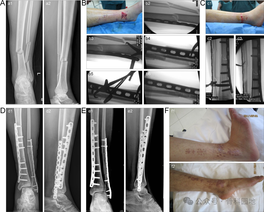 经皮钳形复位，微创钢板内固定治疗胫骨干骨折手术技术