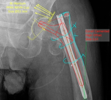 “任性的螺钉”：头髓拉力螺钉盆腔内移位的罕见病例报道