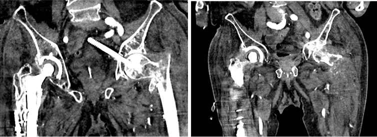 “任性的螺钉”：头髓拉力螺钉盆腔内移位的罕见病例报道
