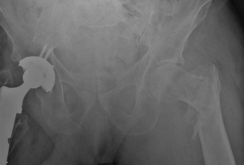 “任性的螺钉”：头髓拉力螺钉盆腔内移位的罕见病例报道