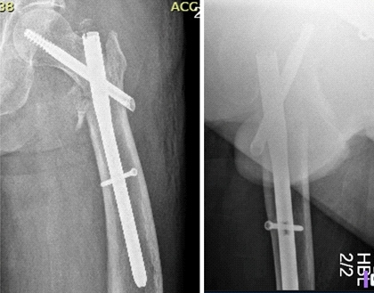 “任性的螺钉”：头髓拉力螺钉盆腔内移位的罕见病例报道