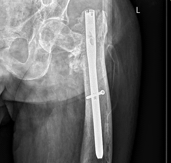 “任性的螺钉”：头髓拉力螺钉盆腔内移位的罕见病例报道