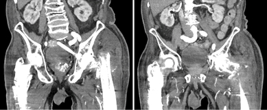 “任性的螺钉”：头髓拉力螺钉盆腔内移位的罕见病例报道