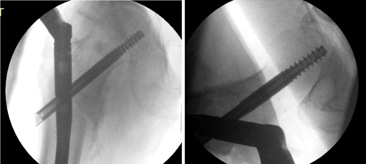“任性的螺钉”：头髓拉力螺钉盆腔内移位的罕见病例报道