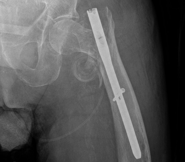 “任性的螺钉”：头髓拉力螺钉盆腔内移位的罕见病例报道