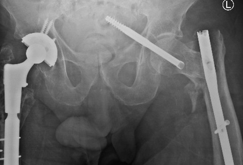 “任性的螺钉”：头髓拉力螺钉盆腔内移位的罕见病例报道