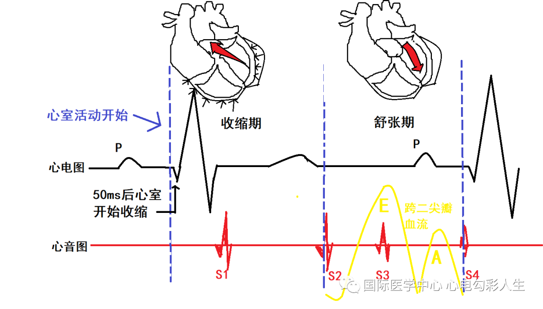 心电图如何报告死亡与濒死心电图​诊断
