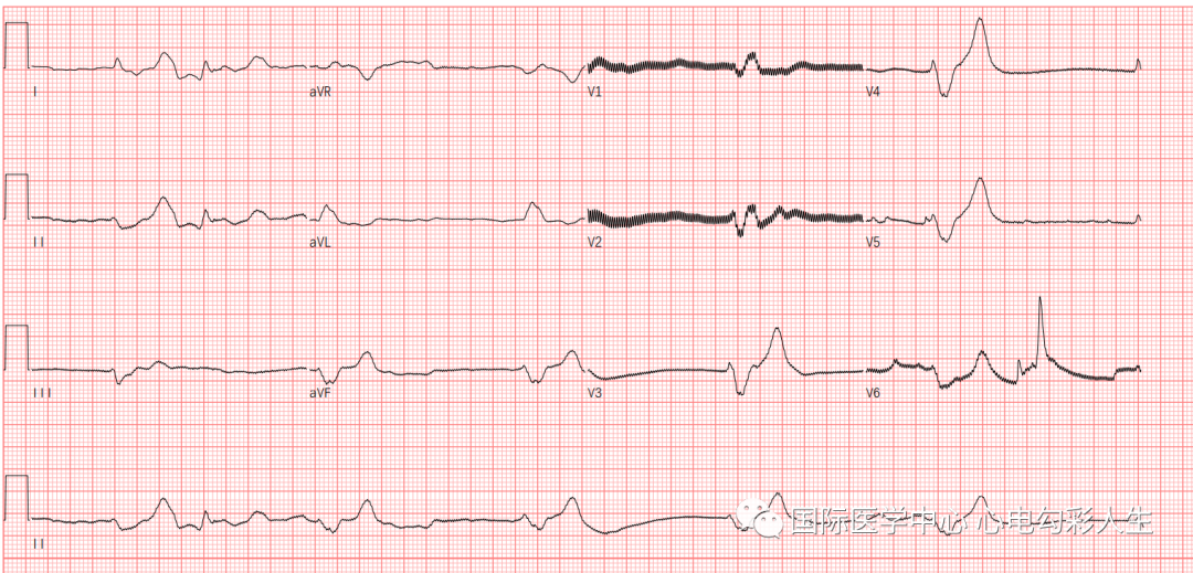 心电图如何报告死亡与濒死心电图​诊断