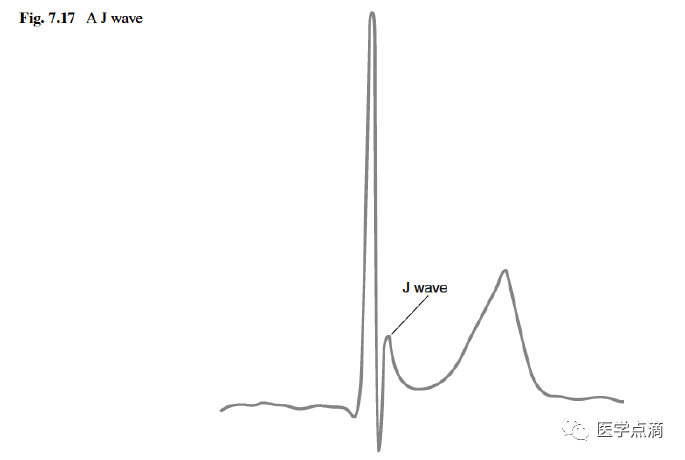 心电图总是记不住？这些基础知识一定要掌握！