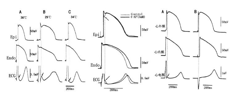 一文道尽『ST-T改变』的种种困惑！