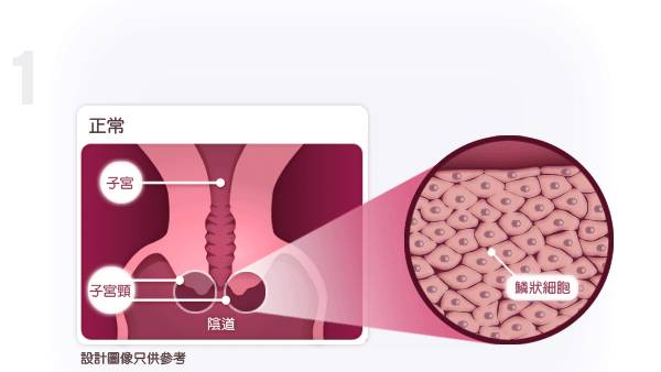台湾长庚质子治 疗妇科癌 