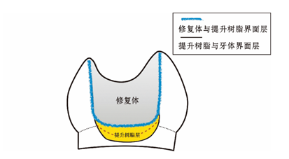 龈壁提升术的临床应用进展分析