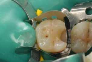 龈壁提升术的临床应用进展分析