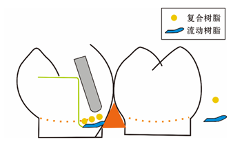 龈壁提升术的临床应用进展分析
