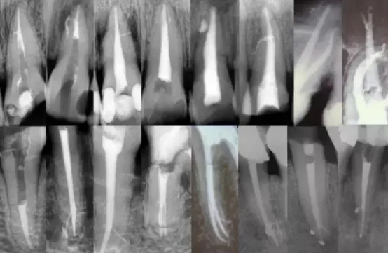 提醒！根管治疗成功，一定要注意这5点