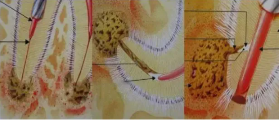 提醒！根管治疗成功，一定要注意这5点