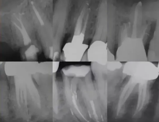 提醒！根管治疗成功，一定要注意这5点