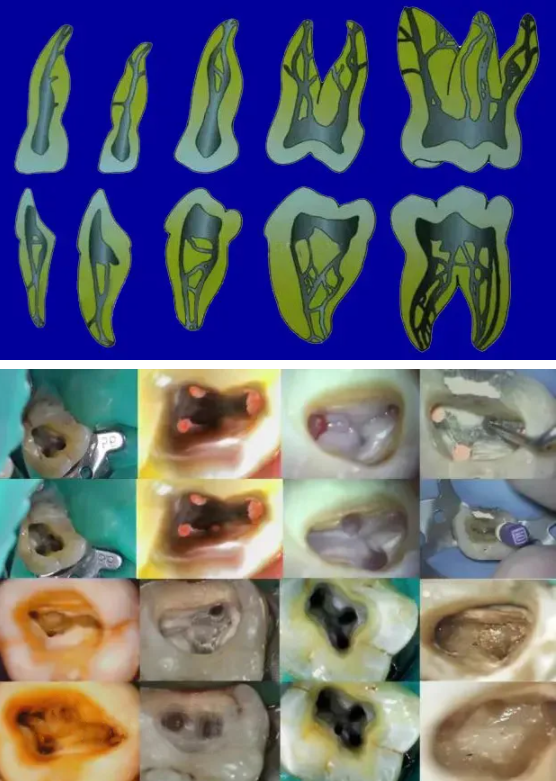 提醒！根管治疗成功，一定要注意这5点