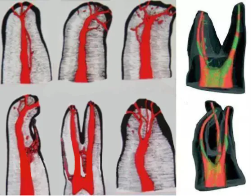 提醒！根管治疗成功，一定要注意这5点