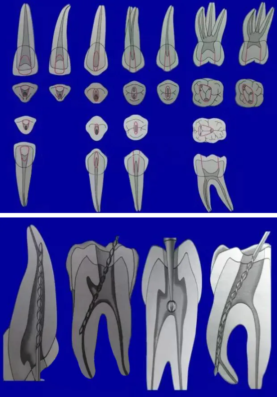 提醒！根管治疗成功，一定要注意这5点