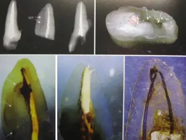 提醒！根管治疗成功，一定要注意这5点