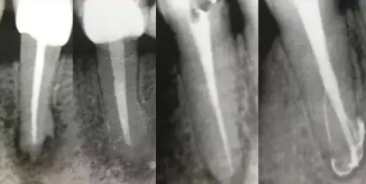 提醒！根管治疗成功，一定要注意这5点