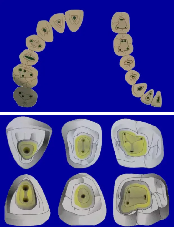 提醒！根管治疗成功，一定要注意这5点