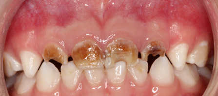 乳前牙透明冠的操作过程及技术要点
