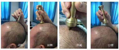 中医特色疗法——杵针疗法