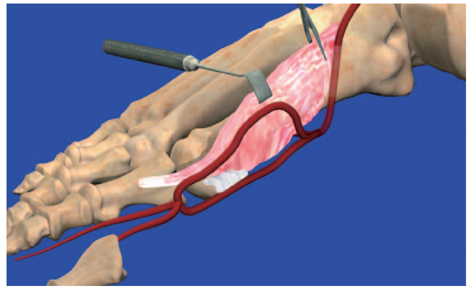 第1跖背动脉解剖与分型