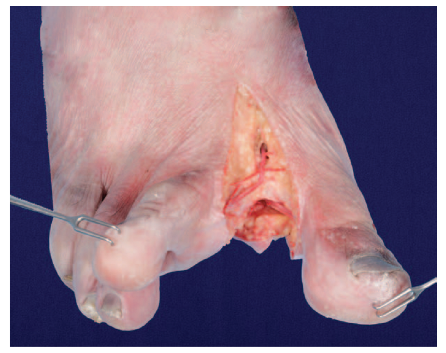 第1跖背动脉解剖与分型