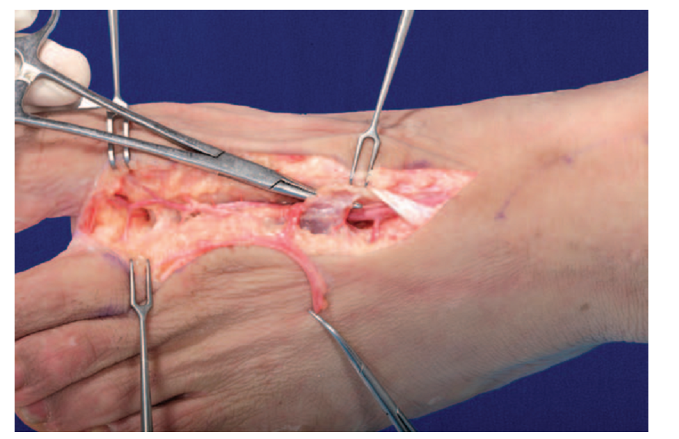 第1跖背动脉解剖与分型