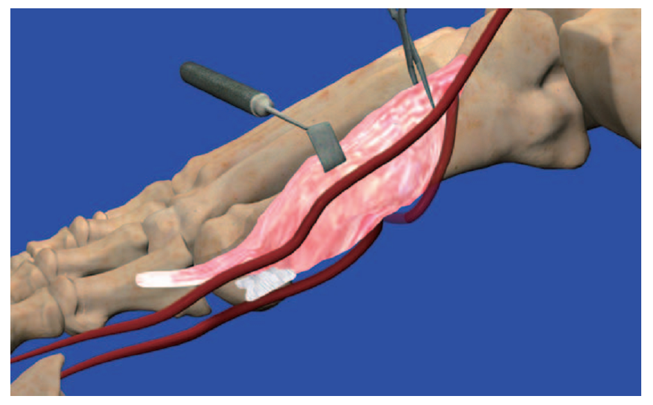 第1跖背动脉解剖与分型