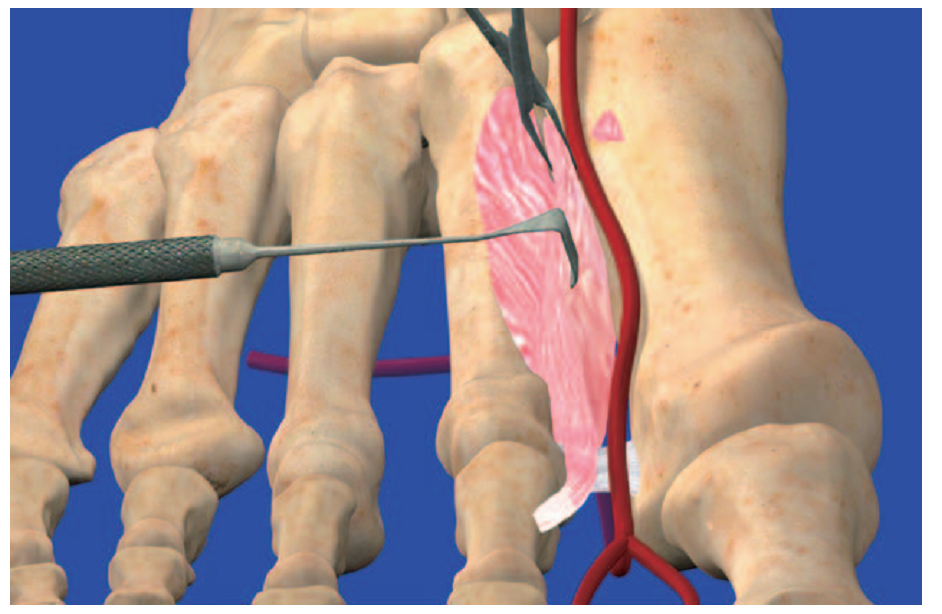 第1跖背动脉解剖与分型