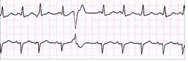 这些特征心电图改变，都是猝死的前兆