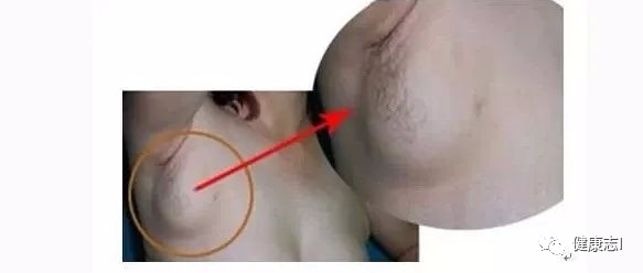 得了乳腺癌，身体上有一个征兆很突出，一出现容易确诊癌变