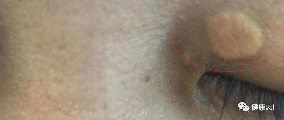 无论男女：眼睛边上长出1物，很可能胆固醇太高，大脑心脏都危险